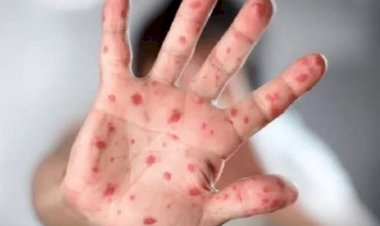 جدري القرود يغزو قطر ويثير ذعر الحكومة.. ماذا يحدث في الدوحة بعد انتشار الفيروس؟