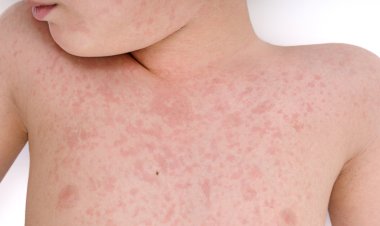 «طفح جلدي» يدق ناقوس الخطر في إنجلترا