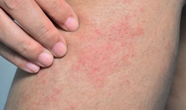 البقع الحمراء على الجلد: الأسباب والعلاج