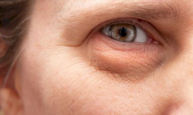 طرق فعّالة لعلاج انتفاخ تحت العين واستعادة نضارة الوجه