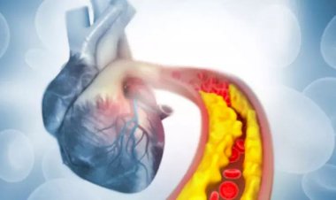 انسداد وتصلب الشرايين.. الأعراض والأسباب والعلاج والوقاية