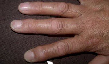 تعرف على أعراض التهاب المفاصل الروماتويدي