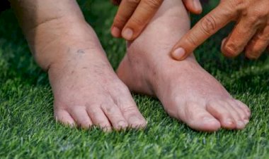 تقرير طبي.. علامات ارتفاع نسبة الأملاح في الجسم وطرق العلاج