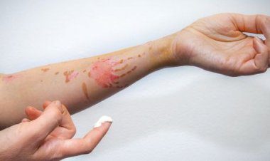 إسعافات وعلاج الحروق من الدرجة الأولى