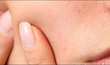 تعرف على علاج الحبوب تحت الجلد