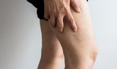 جلطة الساق تجلط الأوردة العميقة.. الأسباب والأعراض والتشخيص والعلاج