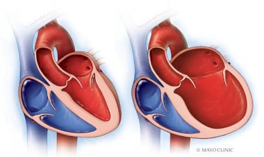 تقرير طبي: التوسُّع العضلي في القلب.. الأعراض والتشخيص والعلاج