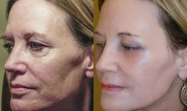 علاج ارتفاع شحوب الوجه