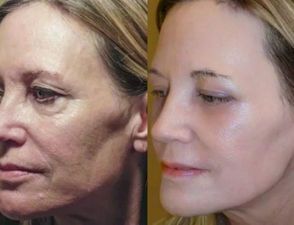 علاج ارتفاع شحوب الوجه