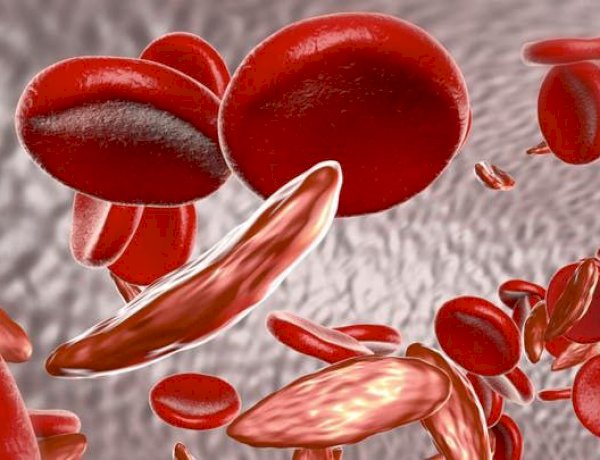 خطورة نقص الحديد بالجسم.. الأعراض والعلاج