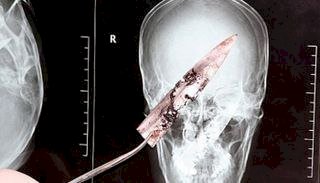 دون أن يدري.. تنزاني يعيش 8 سنوات وشفرة سكين مغروسة في صدره