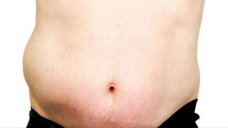 نصائح بعد عملية الفتق الإربي للرجال