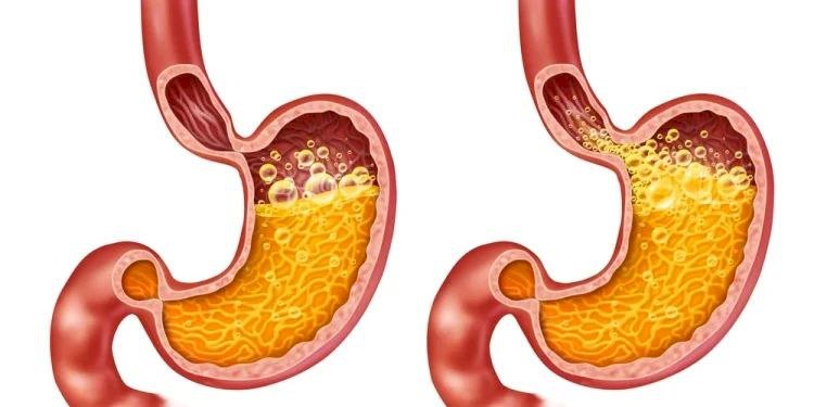 كل ما تحتاج معرفته عن ارتجاع المريء.. الأسباب والأعراض وخيارات العلاج