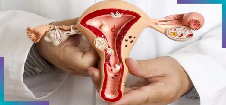 تقرير عن سرطان بطانة الرحم