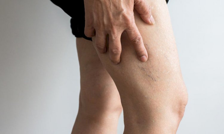 جلطة الساق تجلط الأوردة العميقة.. الأسباب والأعراض والتشخيص والعلاج