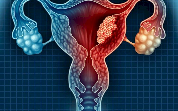 تقرير حول سرطان عنق الرحم.. الأسباب والأعراض والوقاية